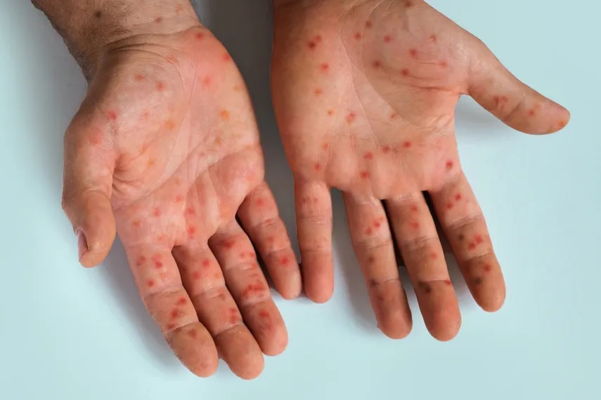 Monkeypox