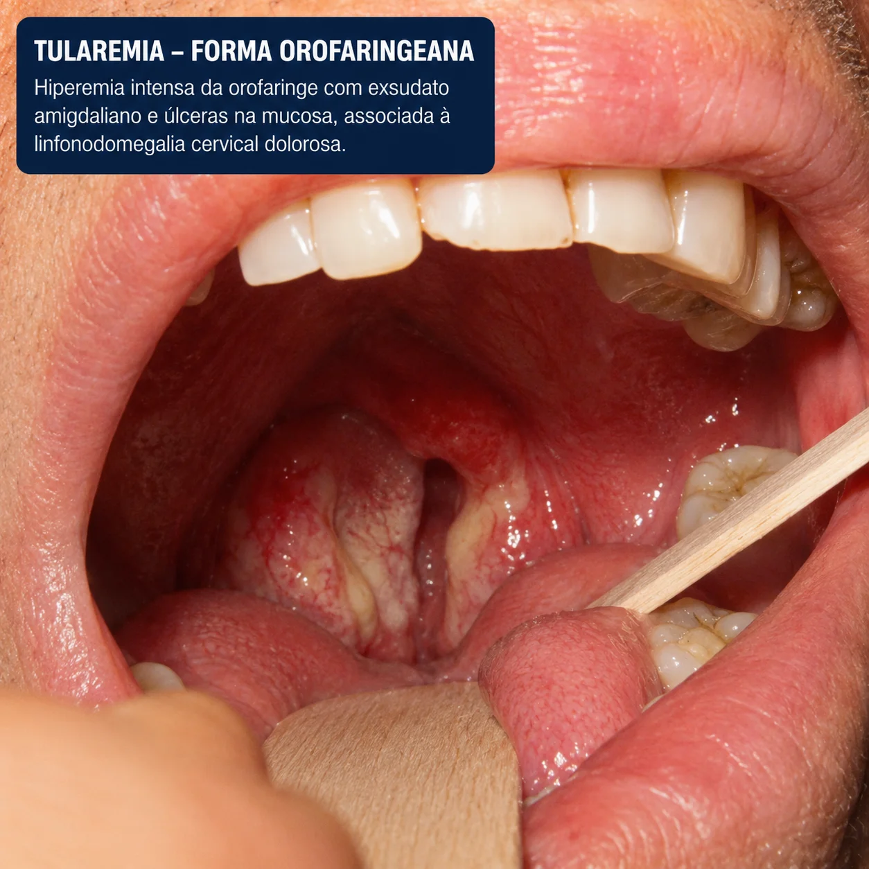 Forma orofaringeana da tularemia