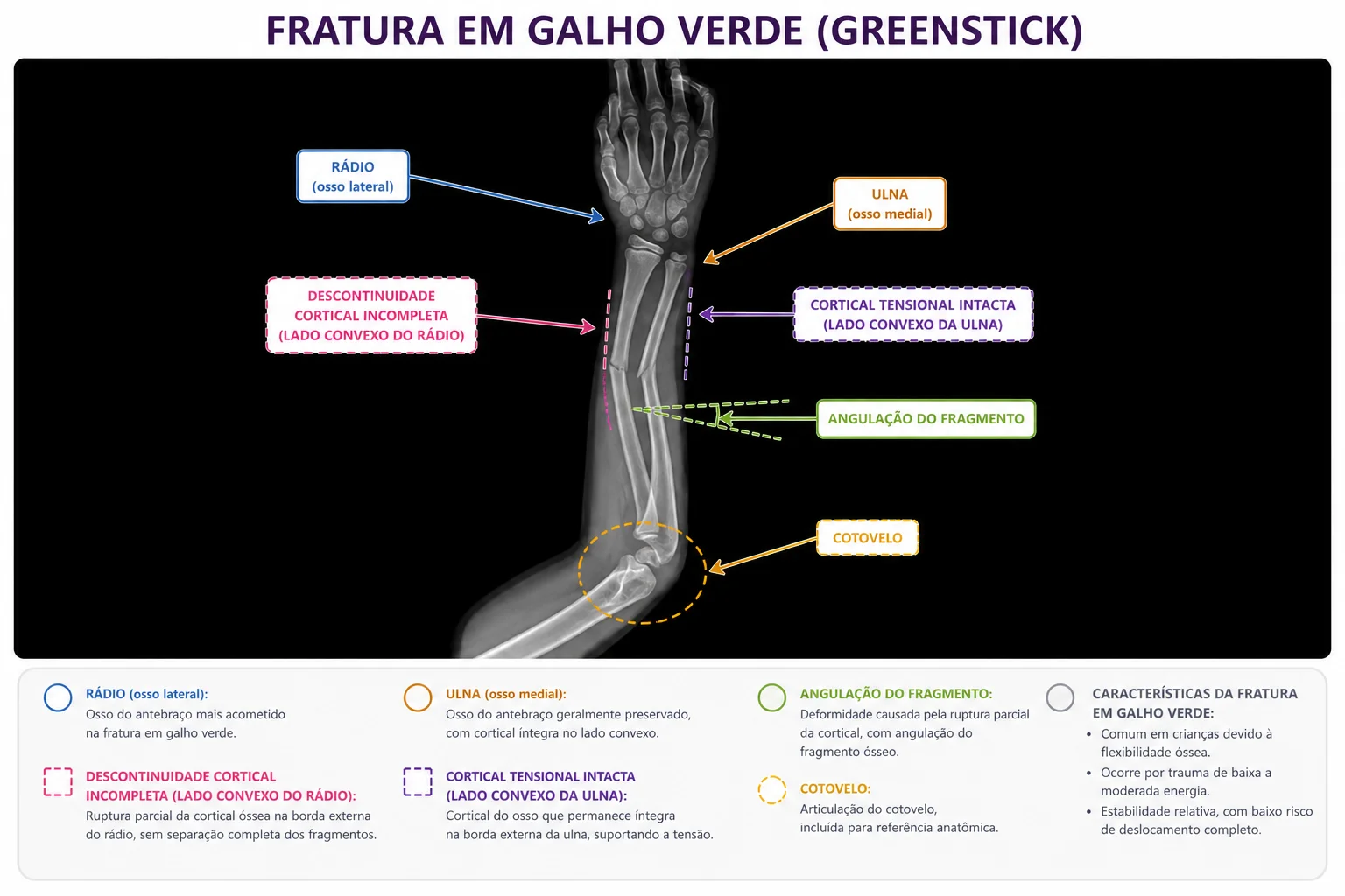 Radiografia de Fratura em Galho Verde