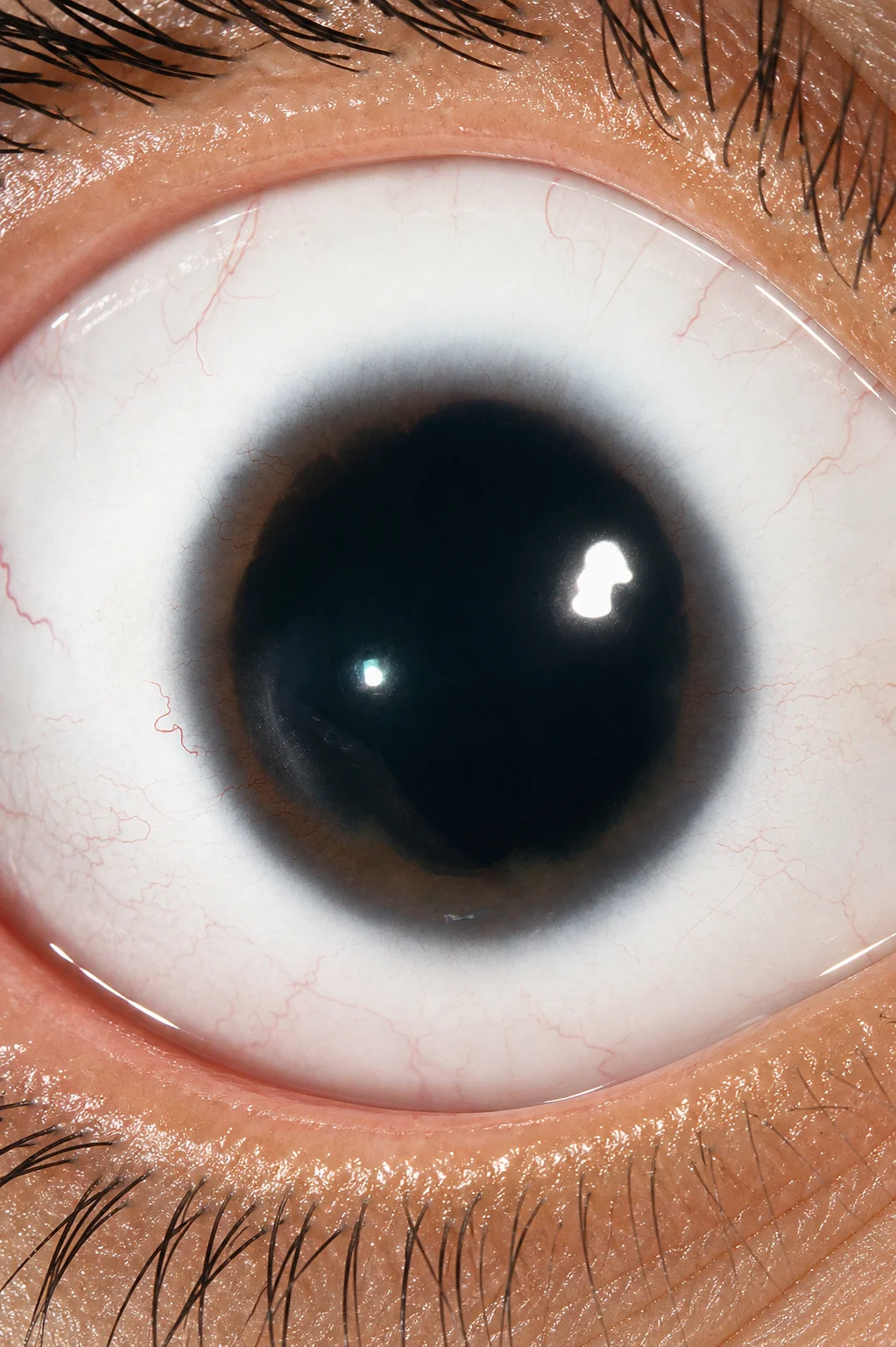 Aniridia