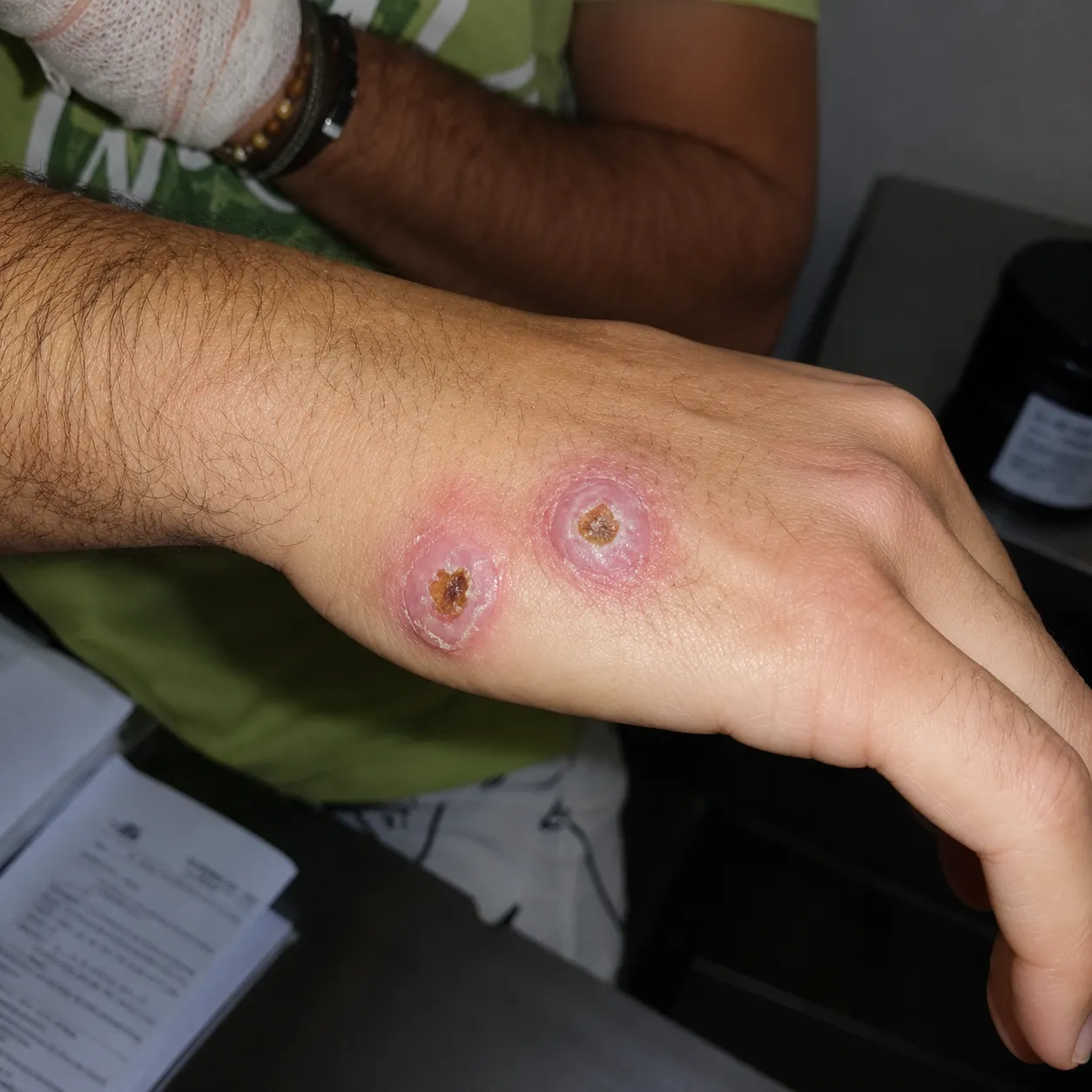 Lesão cutânea da doença da arranhadura do gato