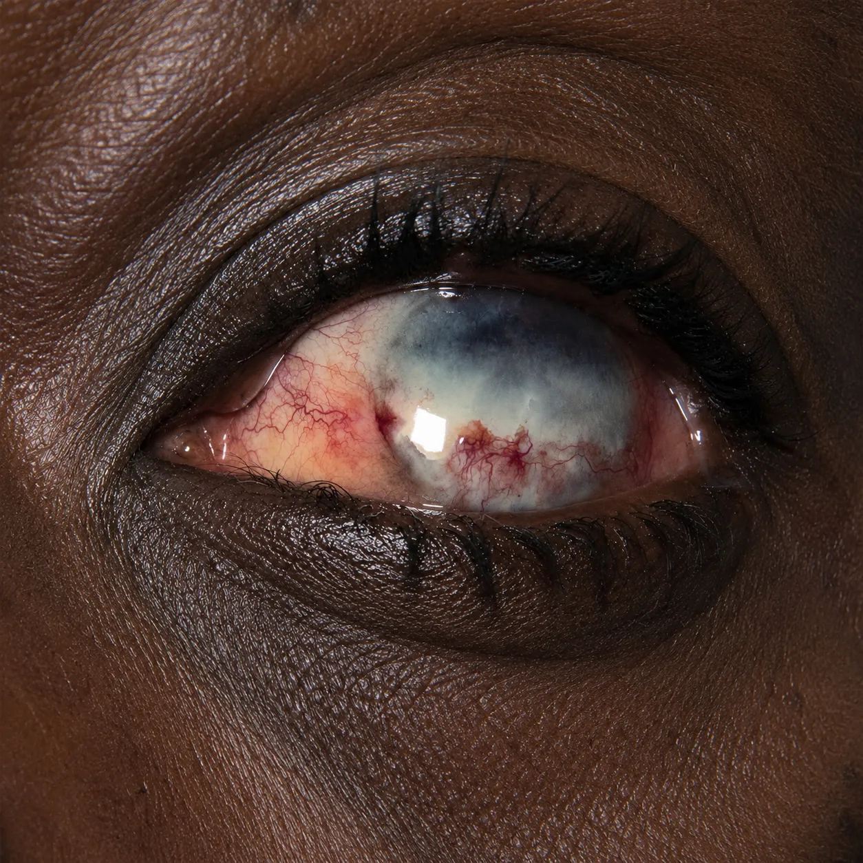 Oncocercose ocular