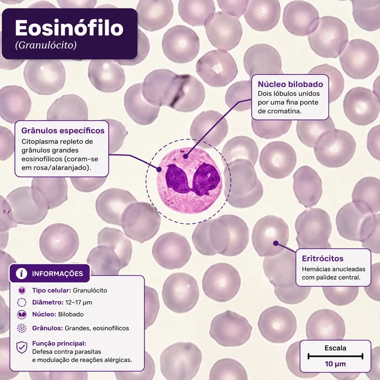 Eosinófilo em esfregaço sanguíneo — imagem 3