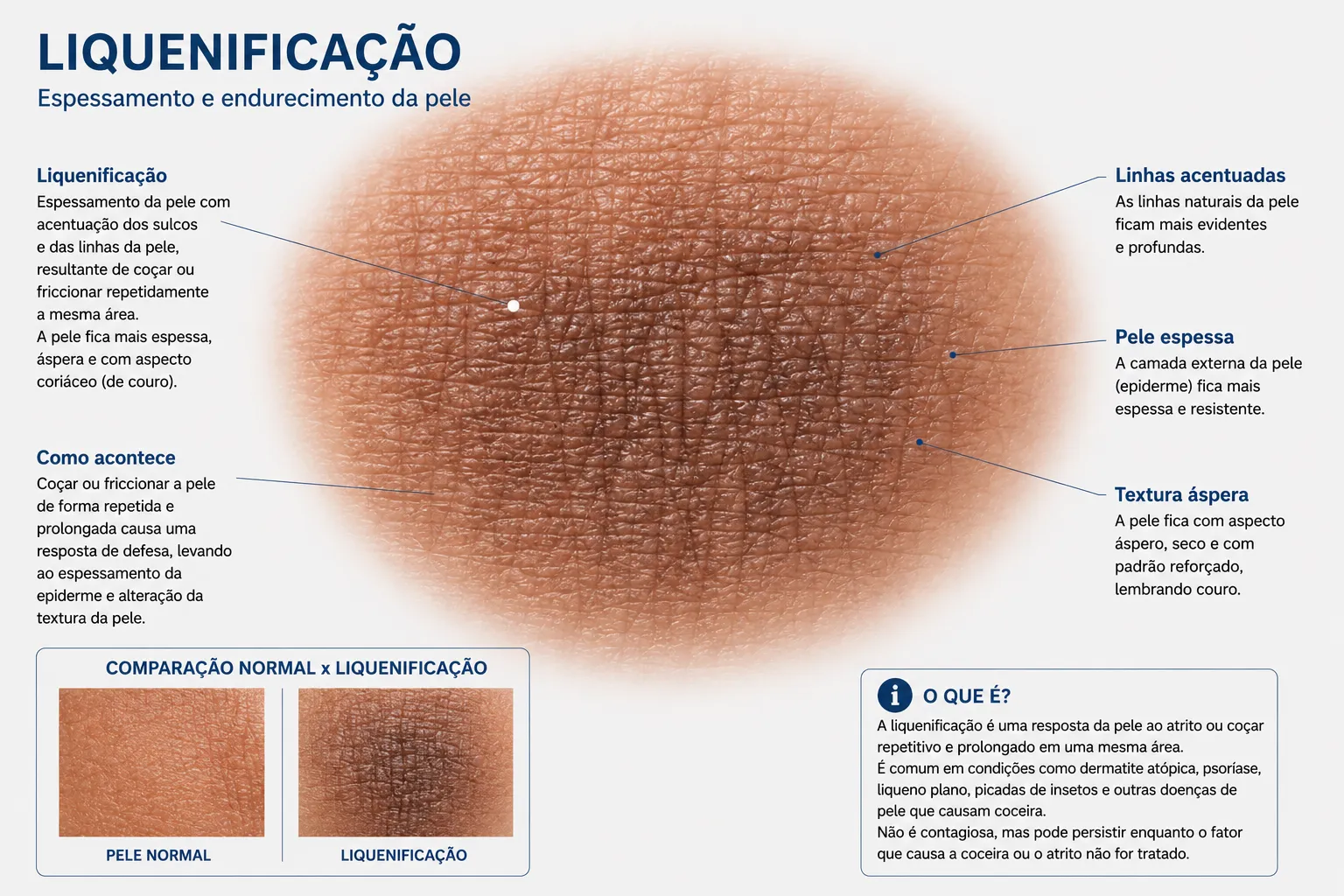 Estruturas em destaque da liquenificação