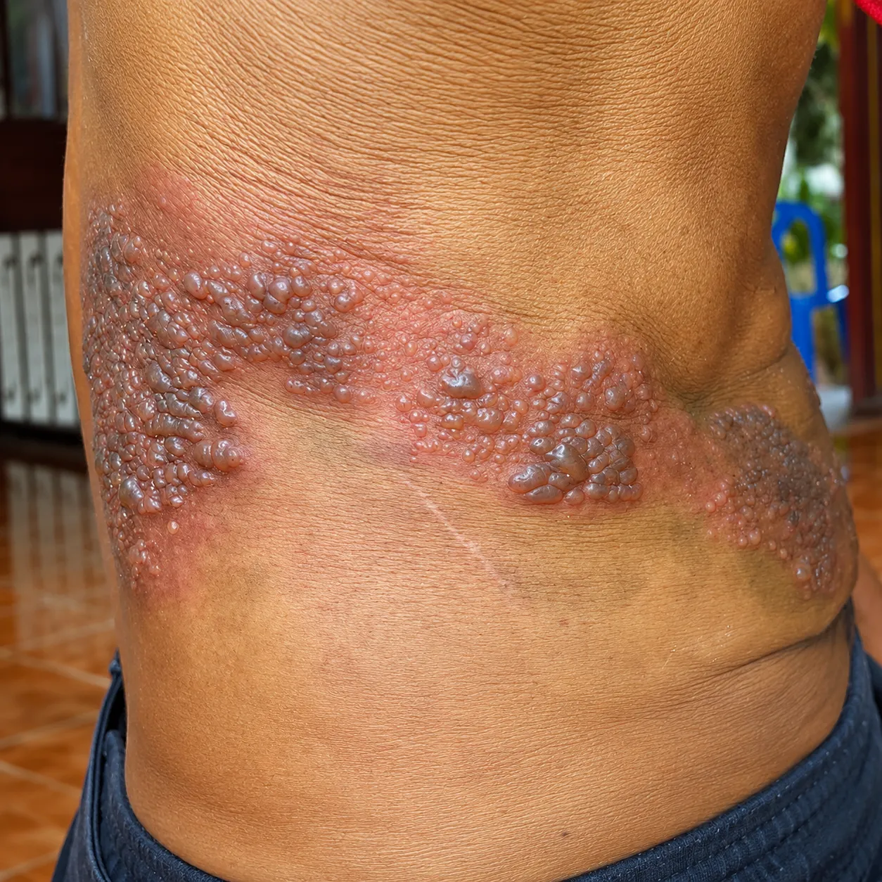 Herpes Zoster - Foto 1