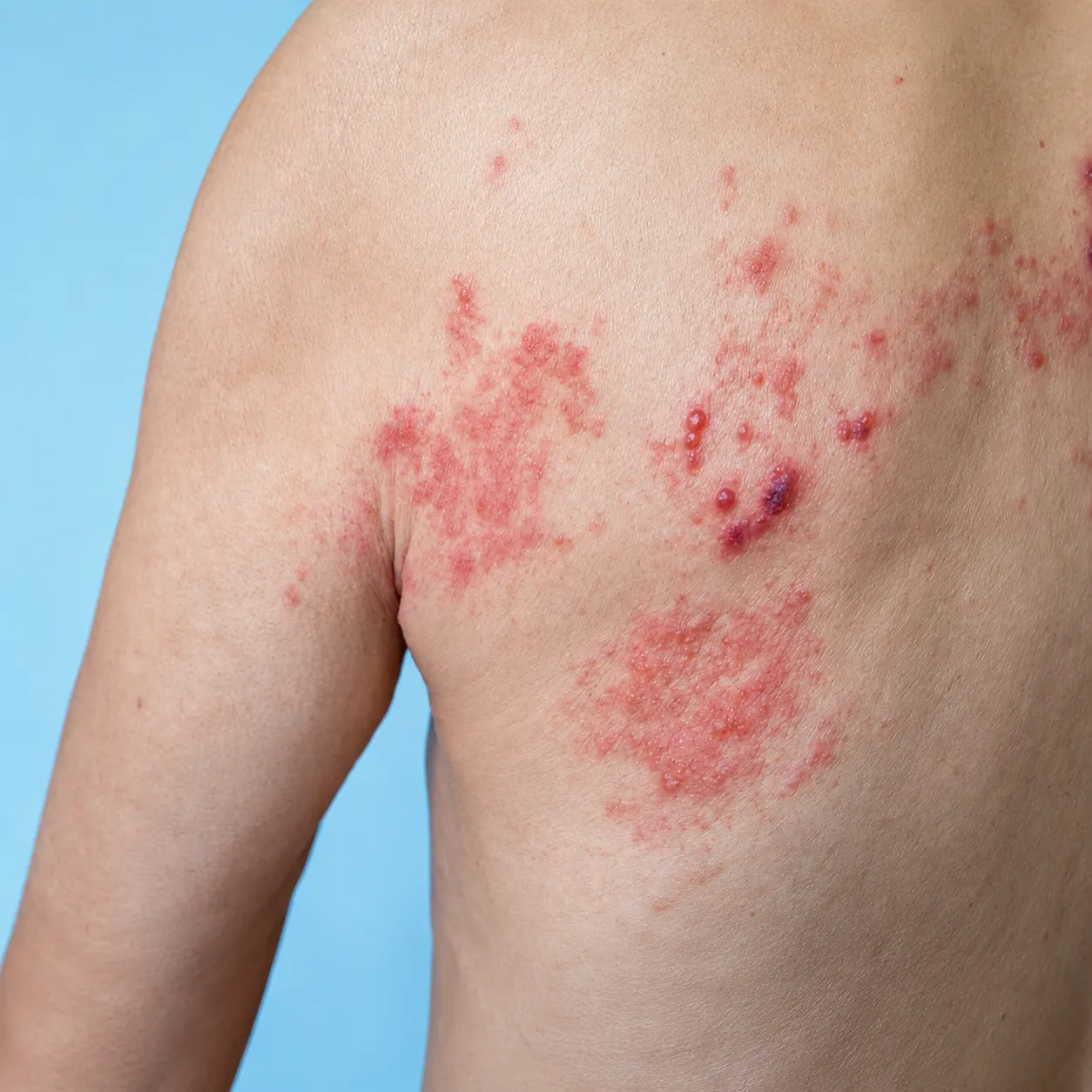 Herpes Zoster