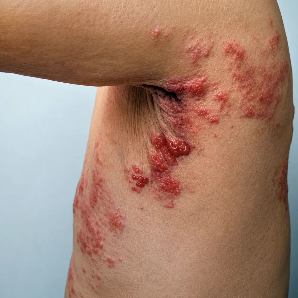 Herpes Zoster - Foto 4