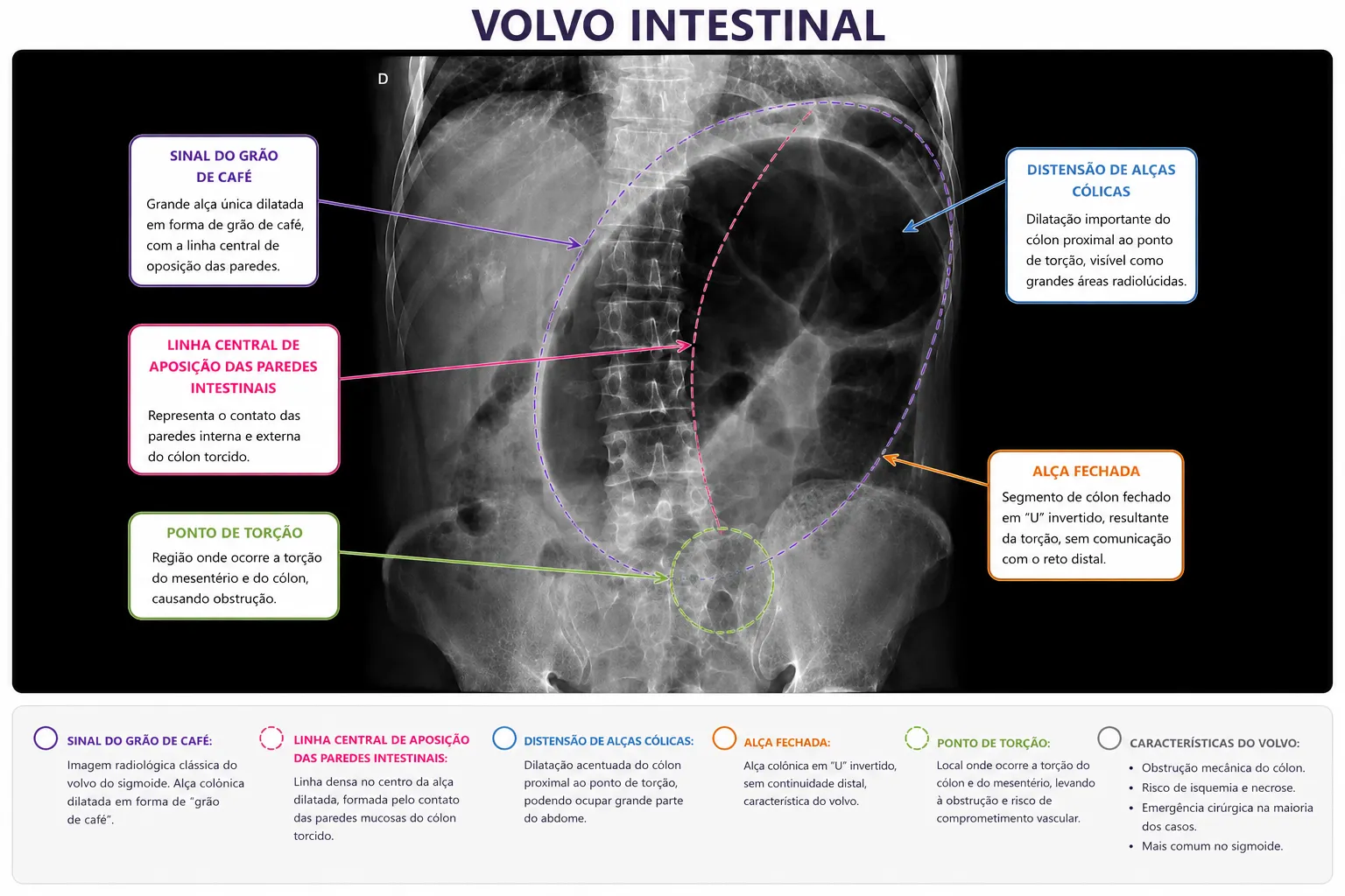 Imagem radiológica de vólvulo