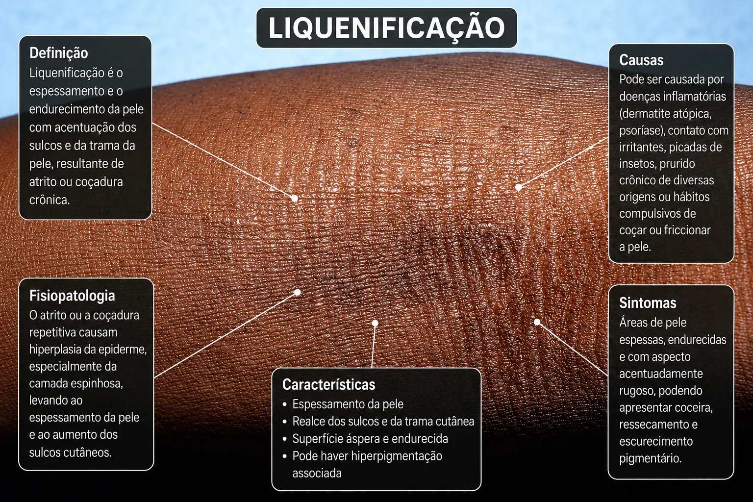 Liquenificação