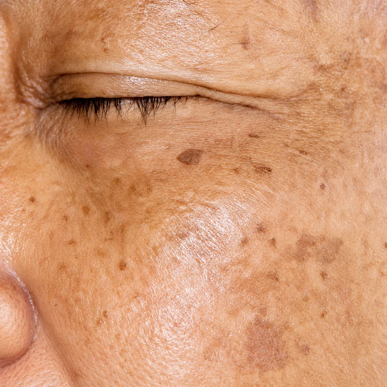 Melasma