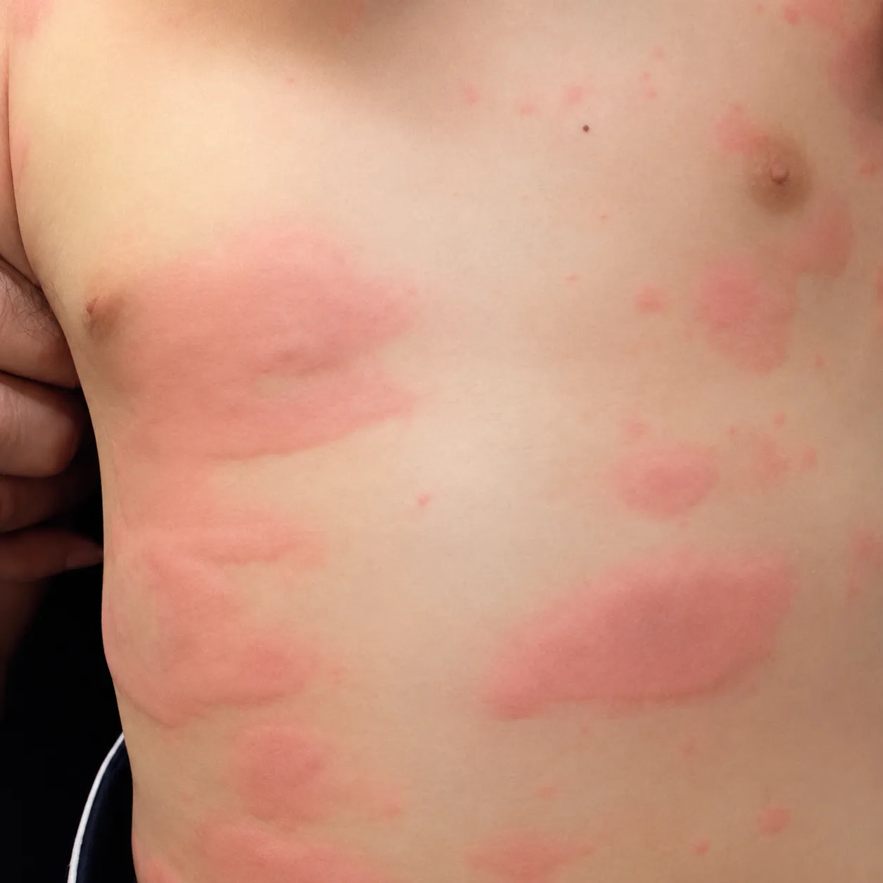 Placa dermatológica - Foto 1
