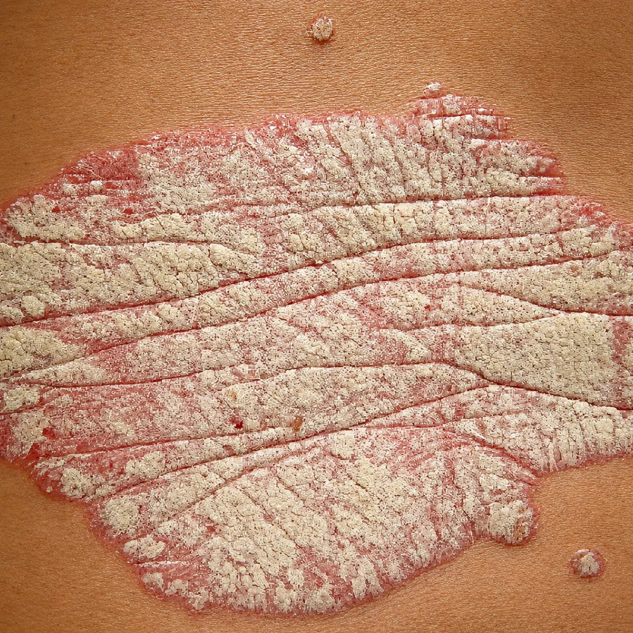 Placa dermatológica - Foto 2