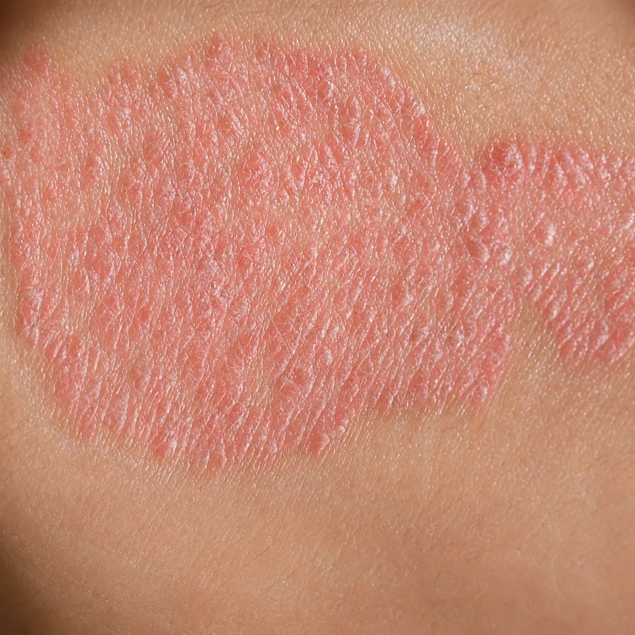 Placa dermatológica - Foto 3