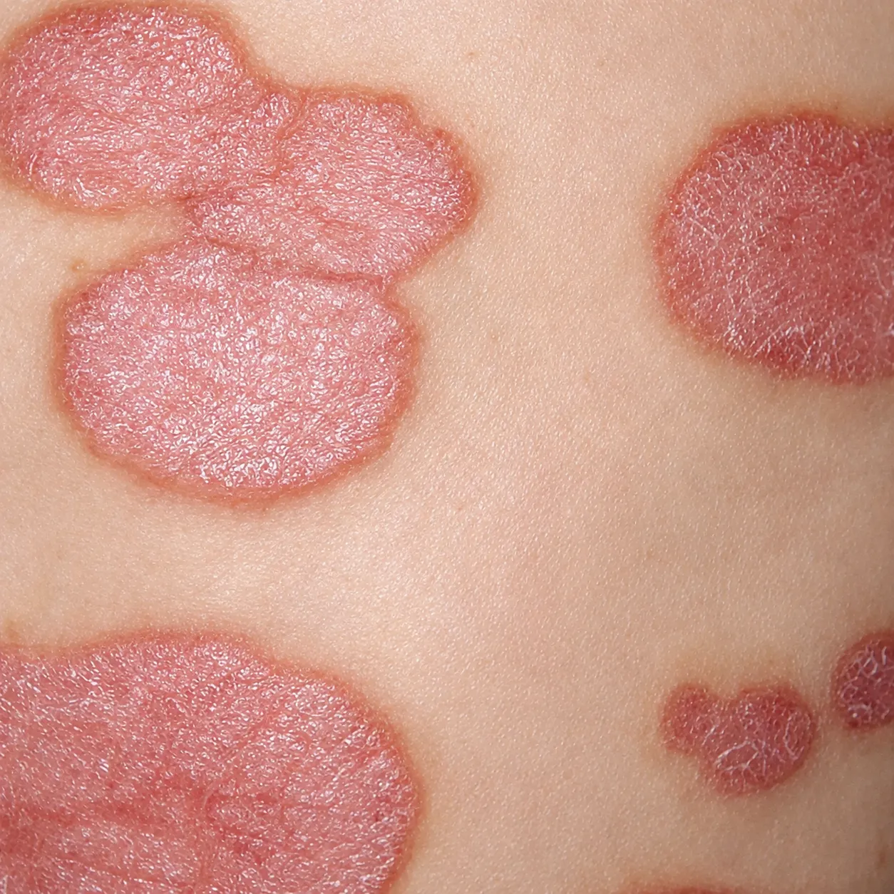 Placa dermatológica - Foto 4