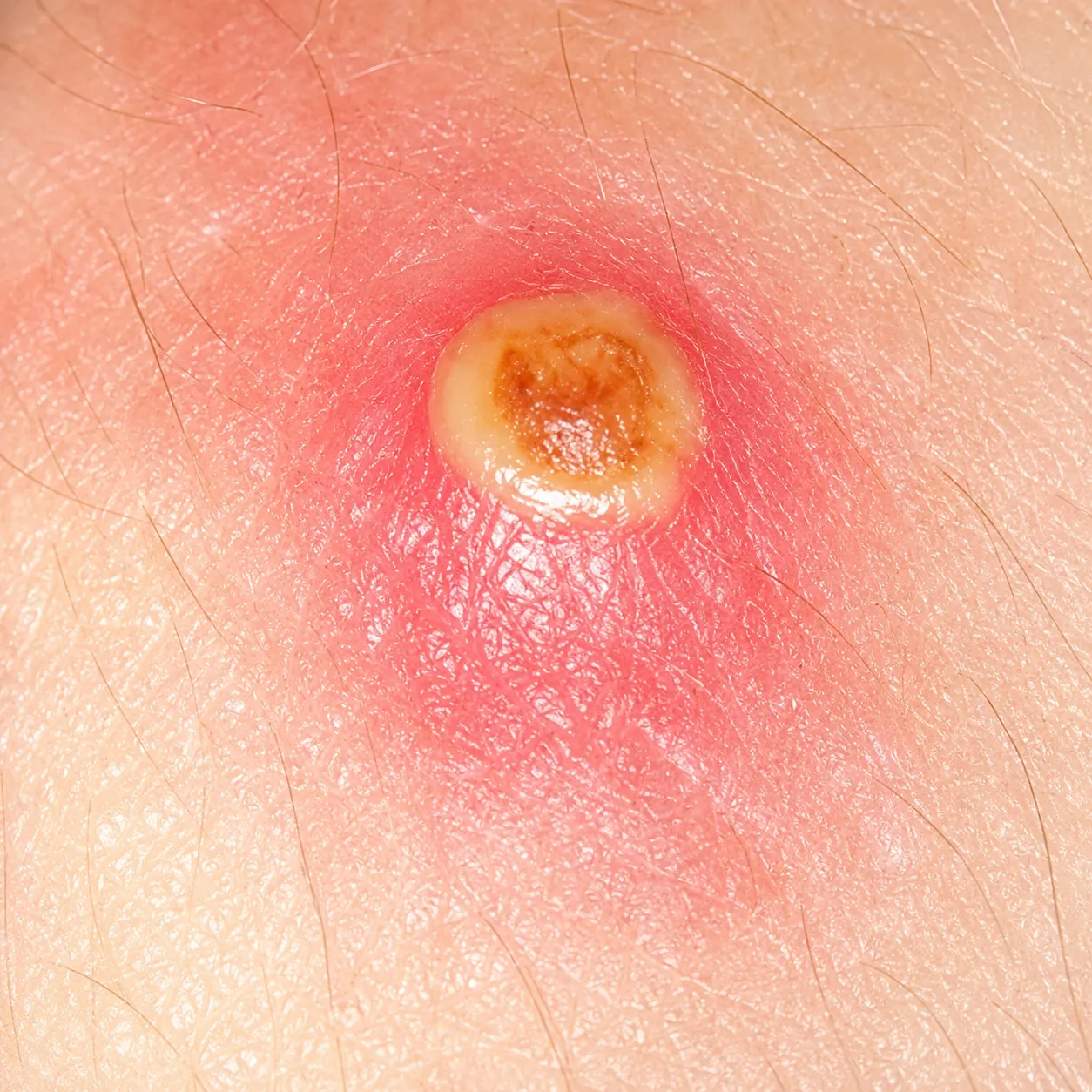 Pústula isolada com base eritematosa