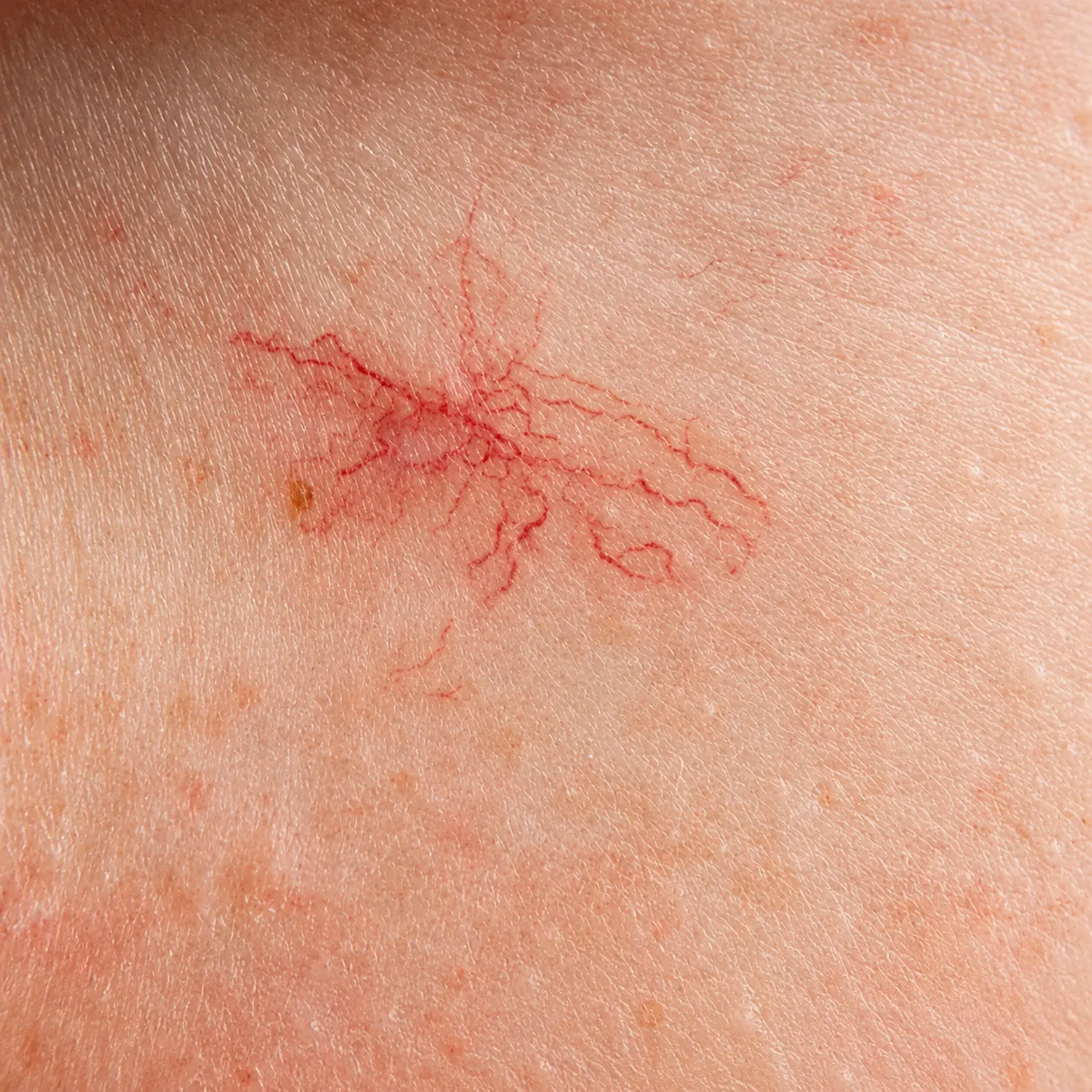 Telangiectasia - Foto 1