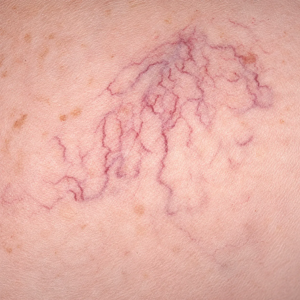 Telangiectasia - Foto 4