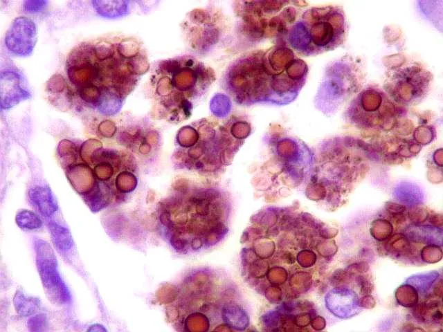 Histologia da histoplasmose com estruturas fúngicas em tecido